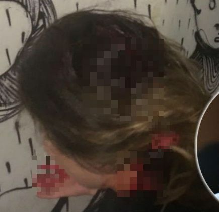 tompazoglou traumatismos