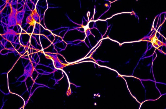 Axons from an Alzheimers mouse model