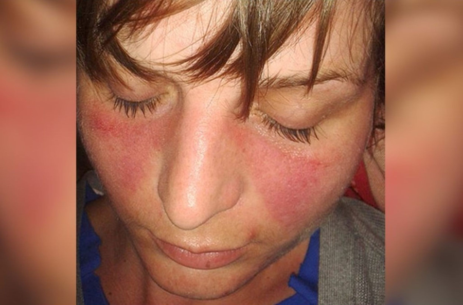 Αποκαλύφθηκε ο μηχανισμός παθογένεσης του λύκου