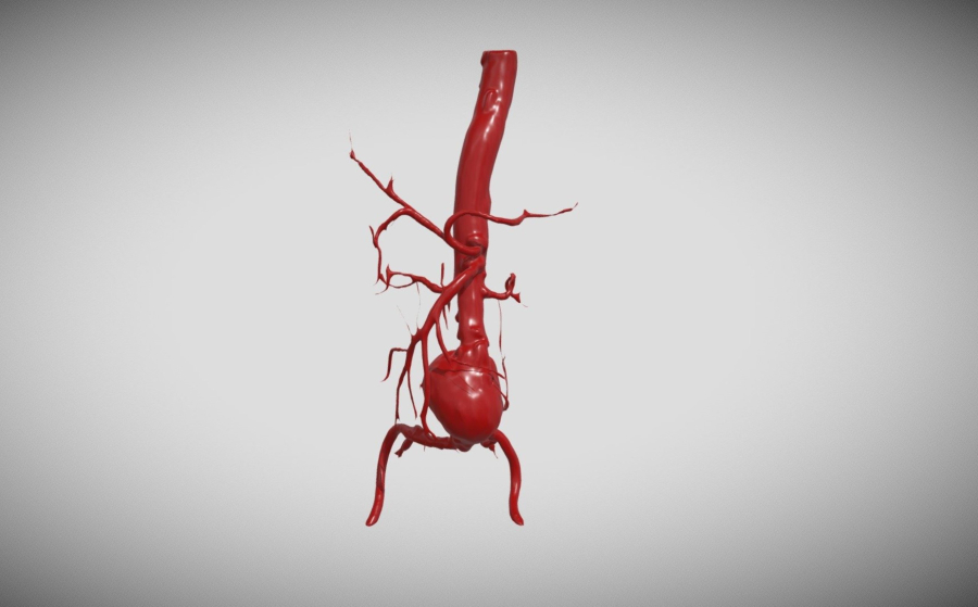 Πως μια εικονική αορτή μπορεί να «σώσει» την πραγματική