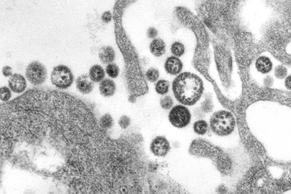 Πυρετός Lassa: Ένας θάνατος στην Αϊόβα - Εξαιρετικά σπάνια περίπτωση