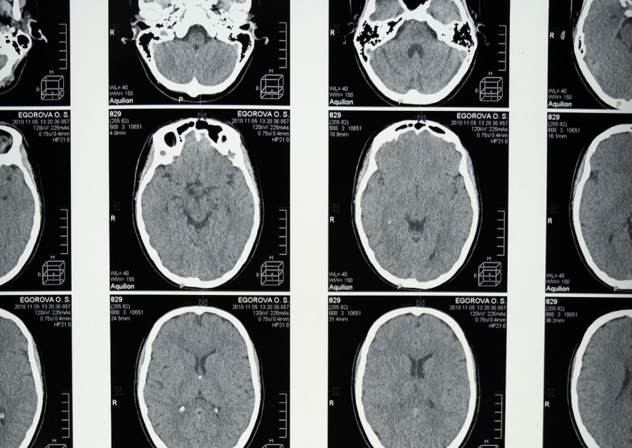 Μεγαλύτερος ο κίνδυνος της επιληψίας μετά από νόσηση με κορονοϊό παρά μετά από γρίπη