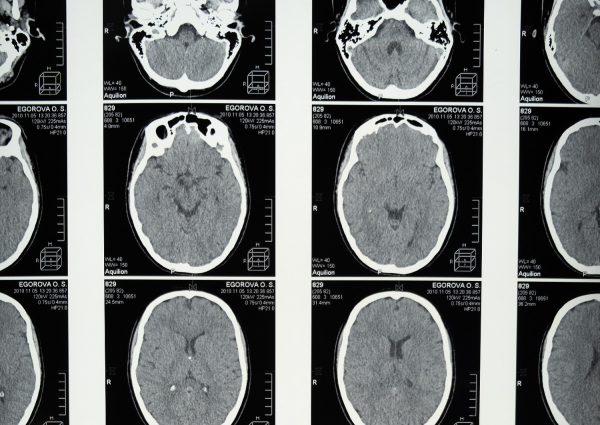 Μεγαλύτερος ο κίνδυνος της επιληψίας μετά από νόσηση με κορονοϊό παρά μετά από γρίπη
