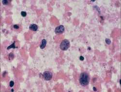 Αυτές είναι οι περιοχές της Ελλάδας που θερίζει ο καρκίνος