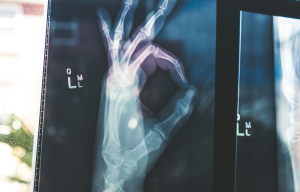 Επεμβατική ακτινολογία για ανακούφιση από τον πόνο: Πώς βοηθά ασθενείς με καρκίνο