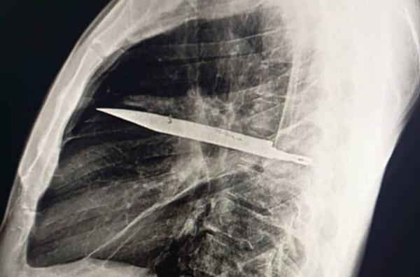Πήγε στο νοσοκομείο και ακτινογραφία έδειξε ότι είχε μαχαίρι στο στήθος για 8 χρόνια