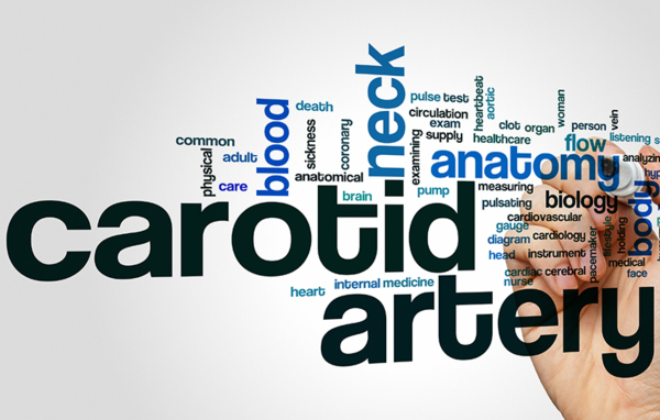 Στένωση καρωτιδικής αρτηρίας: Μία σιωπηλή απειλή