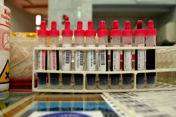 Νέο τεστ αίματος προβλέπει την εξέλιξη της Πολλαπλής Σκλήρυνσης στους ασθενείς
