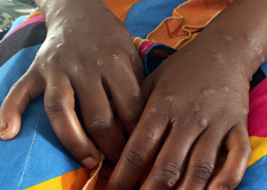 Νέος συναγερμός για την επιδημία mpox