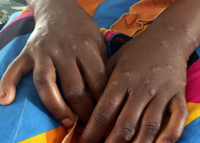 Νέος συναγερμός για την επιδημία mpox