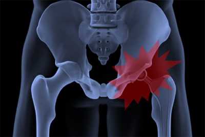 Ολες οι εξελίξεις για την ολική αρθροπλαστική ισχίου