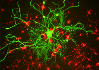 Νέος αλγόριθμος AI ανιχνεύει εγκεφαλικές ανωμαλίες που προκαλούν επιληπτικές κρίσεις