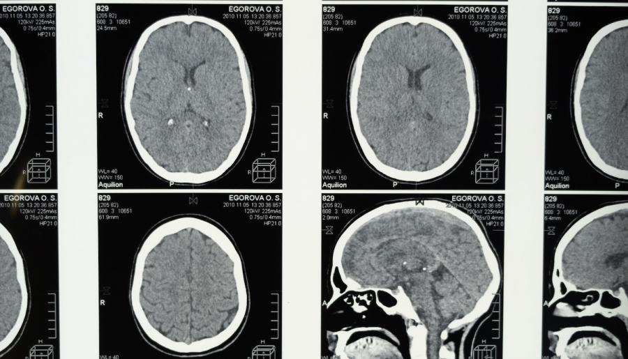 «Κακομαθημένα» κύτταρα του εγκεφάλου προκαλούν την λιποθυμία