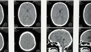 «Κακομαθημένα» κύτταρα του εγκεφάλου προκαλούν την λιποθυμία