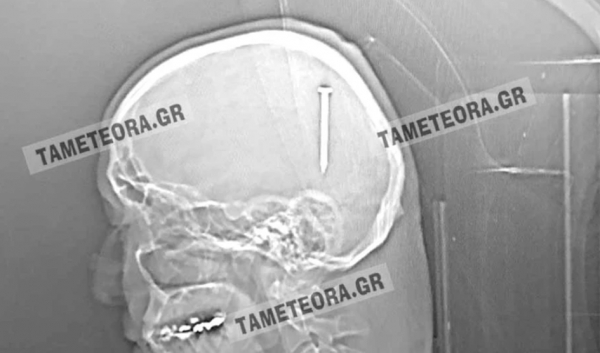 Απίστευτο περιστατικό στην Καλαμπάκα: Σφηνώθηκε καρφί στο κεφάλι άνδρα