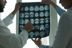 Η περίεργη σχέση μεταξύ της νόσου Αλτσχάιμερ και του καρκίνου