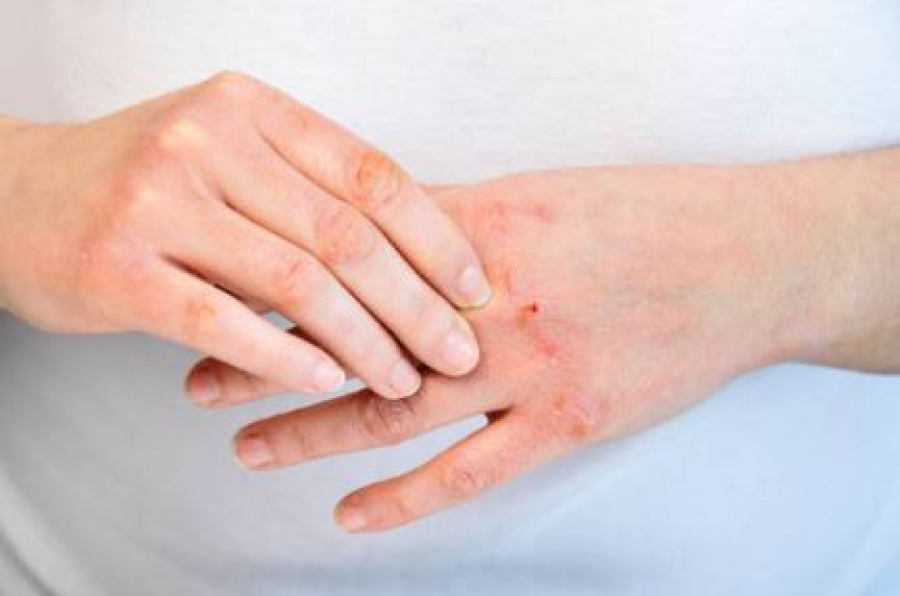 Επιστήμονες ανέπτυξαν μέθοδο για θεραπεία δερματικών λοιμώξεων χωρίς αντιβιοτικά