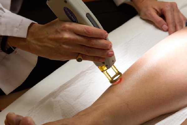 Υπουργείο Υγείας: Μόνο από δερματολόγο λέϊζερ αποτρίχωσης