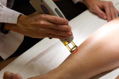 Υπουργείο Υγείας: Μόνο από δερματολόγο λέϊζερ αποτρίχωσης