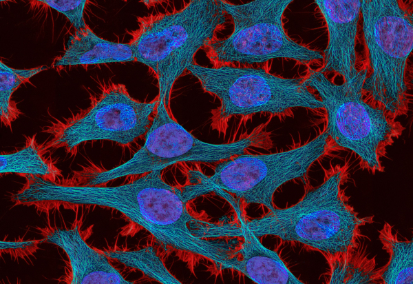 Μπορούμε να μετατρέψουμε τα καρκινικά κύτταρα σε φυσιολογικά; Οι επιστήμονες λένε ότι είναι πλέον δυνατό