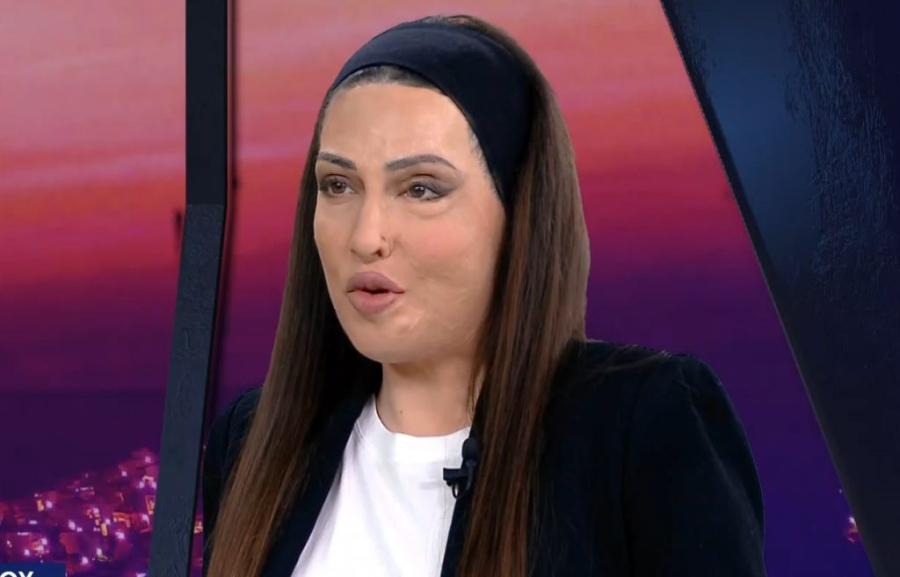 Ιωάννα Παλιοσπύρου: Πέντε χρόνια από την επίθεση με βιτριόλι - Οι φωτογραφίες και το μήνυμα «Μου λείπεις»