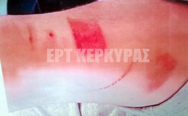 Σάλος με τις καταγγελίες 19χρονου σεφ για βασανιστήρια σε εστιατόριο της Κέρκυρας - Διαψεύδει ο Μποτρίνι (vid)