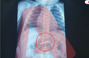 Περιπέτεια για 3χρονο στην Αθήνα έπειτα από κατάποση ξυραφιού