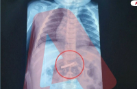 Περιπέτεια για 3χρονο στην Αθήνα έπειτα από κατάποση ξυραφιού