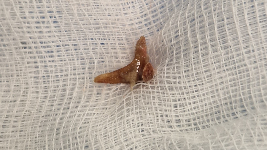 Χανιά: Είχε για μήνες στο πνεύμονά της, κόκκαλο από κουνέλι - Έπαθε σοκ ο γιατρός