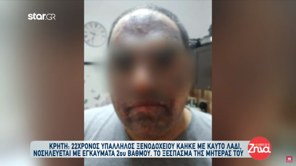 Παρέμβαση της Επιθεώρησης Εργασίας για τον ανασφάλιστο μάγειρα που κάηκε με καυτό λάδι στην Κρήτη