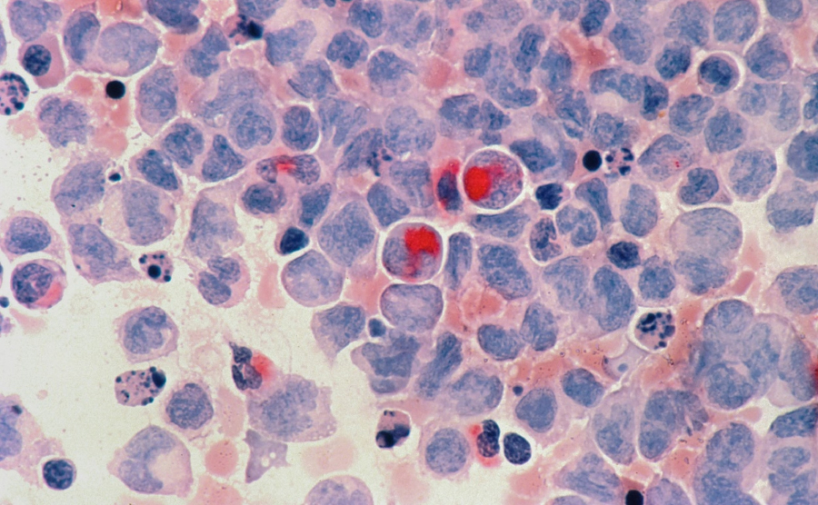 Οι περισσότερες αποτρέψιμες περιπτώσεις καρκίνου σχετίζονται με 2 συνήθειες