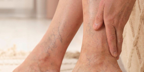 Γιατί πρέπει να χειρουργηθούν οι κιρσοί στα πόδια μου;