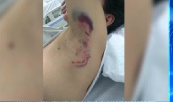 Τρομακτική εμπειρία για 34χρονη στην Καλαμάτα: Αγέλη σκύλων την κατασπάραξε έξω από τη δουλειά της