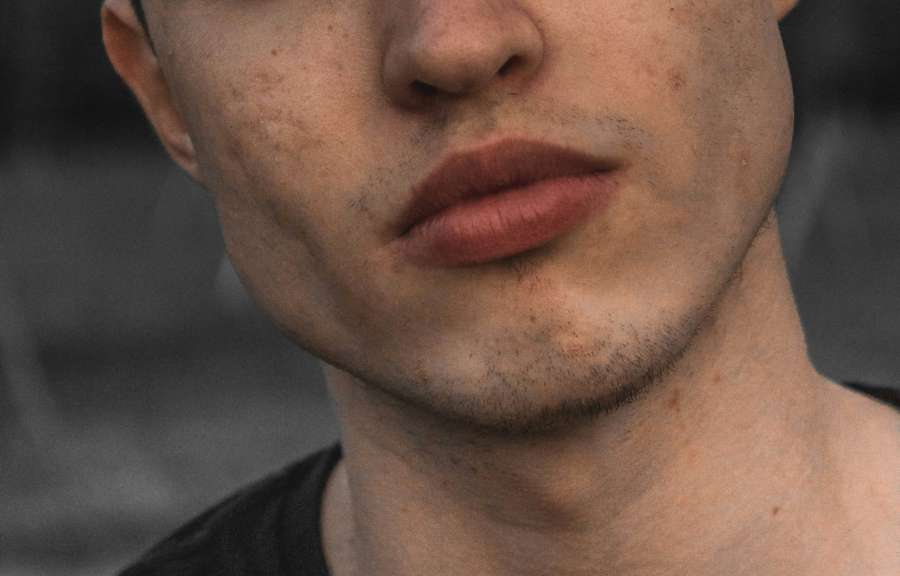 Ανακλήθηκαν αυτές οι κρέμες για την ακμή - Περιέχουν ουσίες που προκαλούν καρκίνο