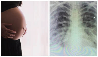 Αγωνία για 4 ανεμβολίαστες εγκύους στο «Ιπποκράτειο»: Σοκάρει ακτινογραφία θώρακος διασωληνωμένης (εικόνα)