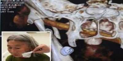 Έπαθαν σοκ οι γιατροί όταν ανακάλυψαν ότι στο πρόσωπό της είχε…