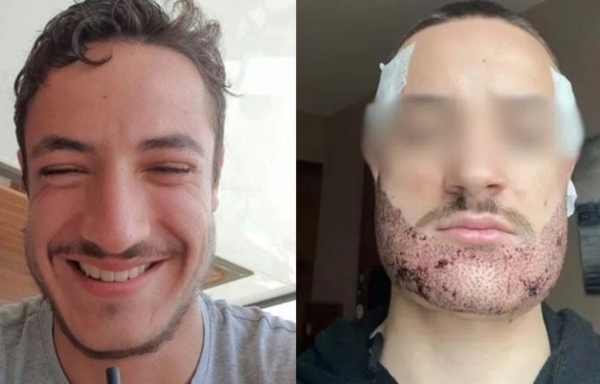 Γαλλία: Αυτοκτόνησε μετά από αποτυχημένη επέμβαση για μούσια στην Τουρκία