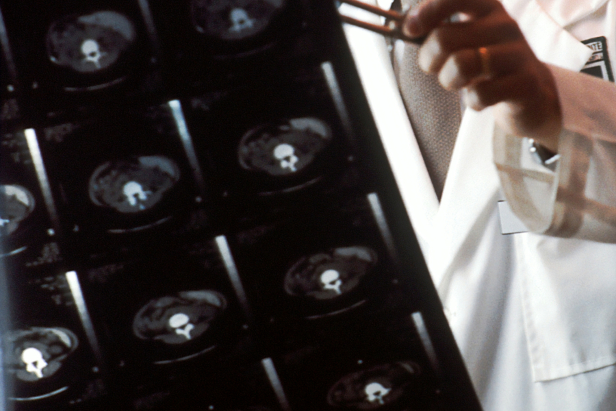 Επιστήμονες εφάρμοσαν για πρώτη φορα επιτυχώς γονιδιακή θεραπεία για την εκφυλιστική νόσο Χάντινγκτον