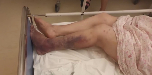 Φρίκη σε γηροκομείο στην Αθήνα: 89χρονη κατέληξε μετά από κακοποίηση - «Είχε μελανιασμένα πόδια και σπασμένα πλευρά»