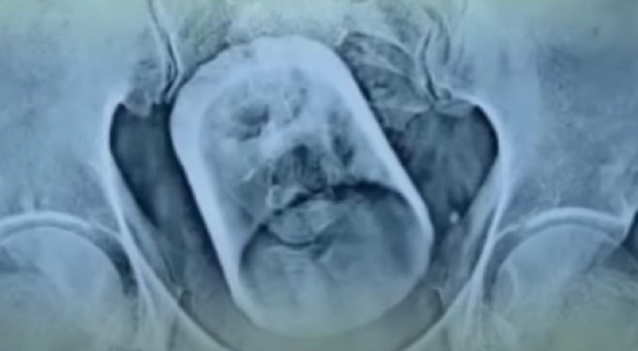 Βρέθηκε γυάλινο ποτήρι στο έντερο του - Τι είπε στους γιατρούς ο 55χρονος