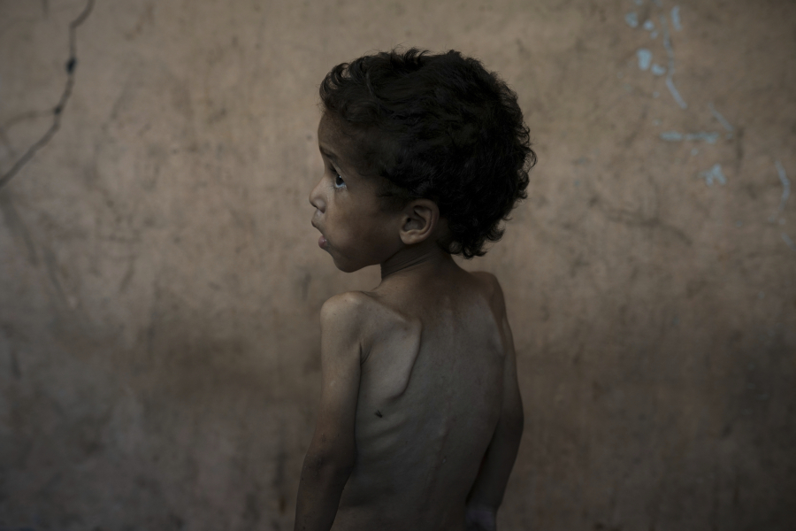 Γάζα: Περισσότερα από 7.000 παιδιά με οξύ υποσιτισμό σε μόλις δύο εβδομάδες