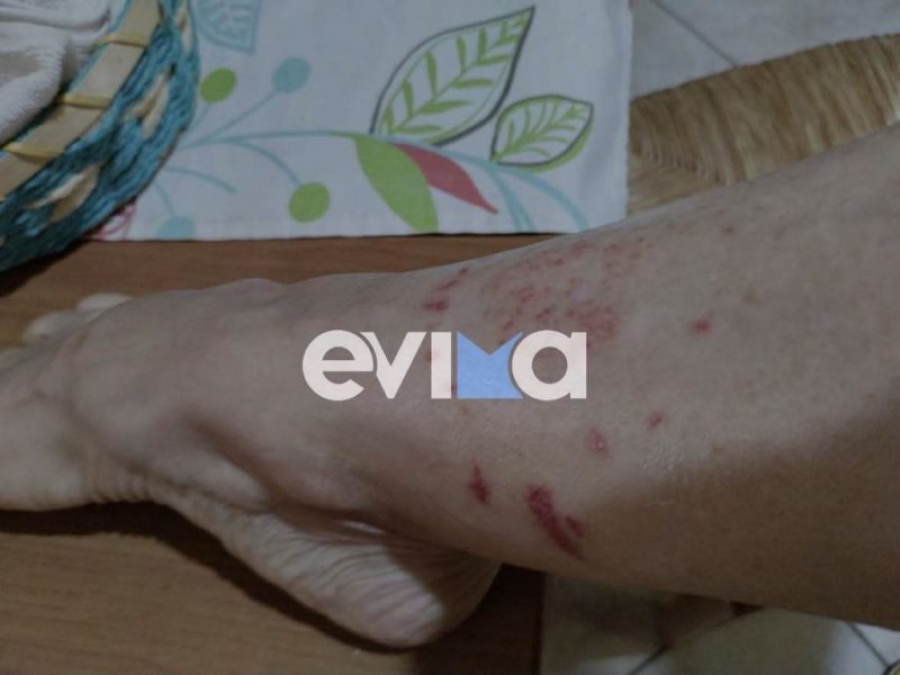 Εύβοια: Τρομακτικό τσίμπημα μωβ μέδουσας στο πόδι (εικόνα)