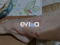 Εύβοια: Τρομακτικό τσίμπημα μωβ μέδουσας στο πόδι (εικόνα)