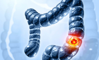 Καρκίνος του παχέος εντέρου: Ποια συμπτώματα προειδοποιούν;