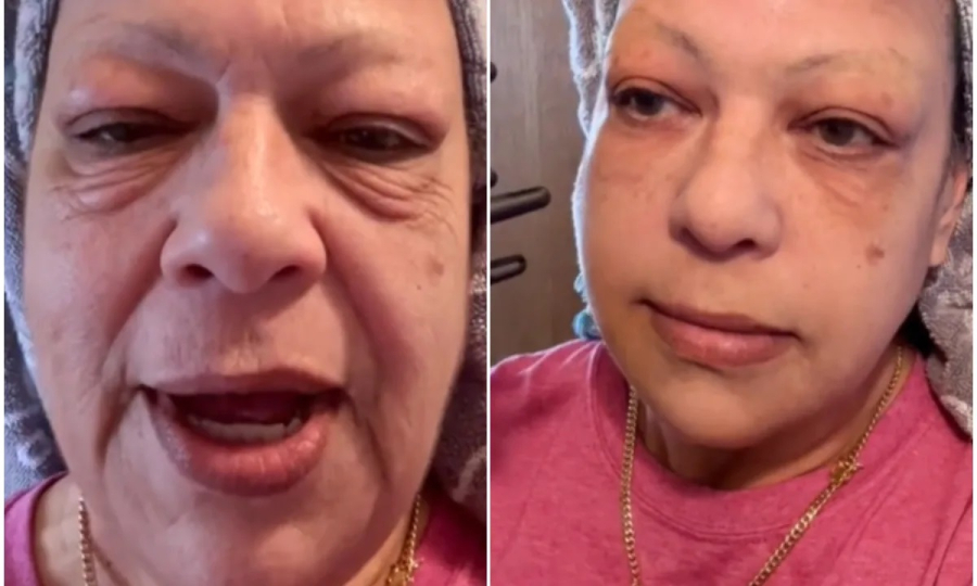 «Λειτουργεί σαν Botox»: Η viral κρέμα του TikTok που εξαφανίζει τις ρυτίδες και τις σακούλες σε λίγα λεπτά