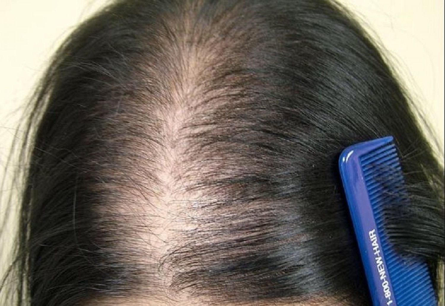 Фото выпавших волос. Ага андрогенная алопеция. Андрогензависимая алопеция. Женская андрогенная алопеция.