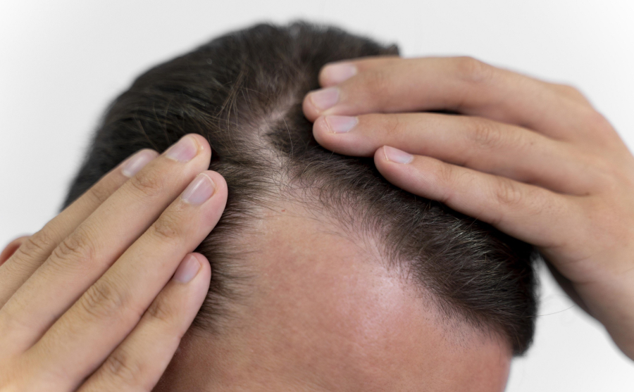 Η διατροφή που «ευνοεί» την τριχόπτωση