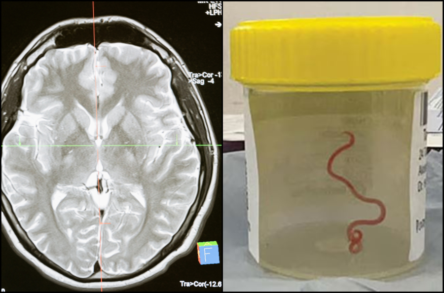 «Δεν θα πιστέψετε τι βρήκα στην ασθενή... κουνιέται»: Πώς βρέθηκε στον εγκέφαλο γυναίκας ζωντανό σκουλήκι