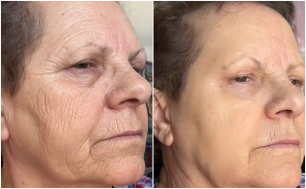 Η κρέμα που γεμίζει τις ρυτίδες σε 30 δευτερόλεπτα – Πώς λειτουργεί (Βίντεο)