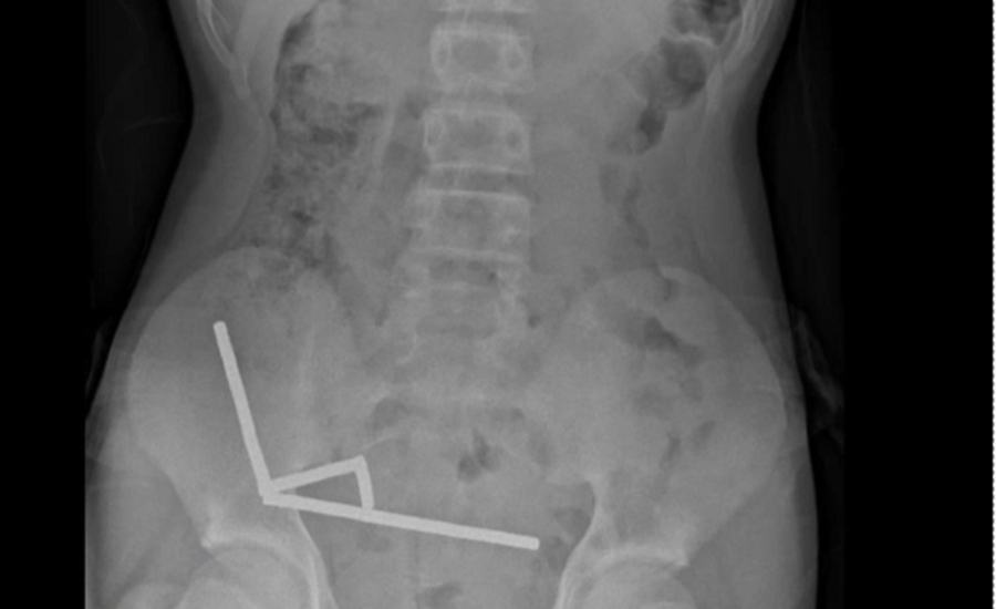 Ν. Ζηλανδία: Χειρουργοί αφαίρεσαν 80-100 μαγνήτες από το έντερο 13χρονου